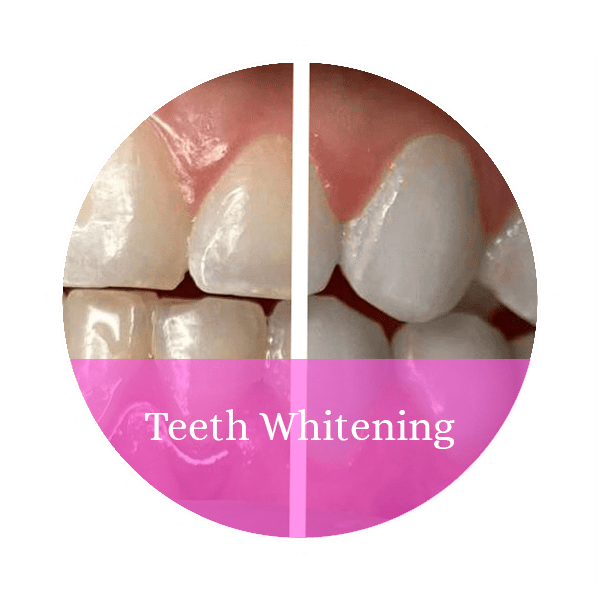 Teeth Whitening Service