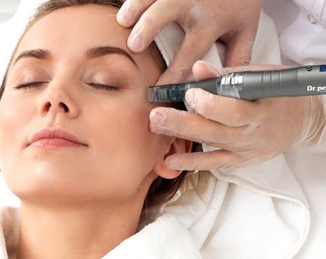 microneedling